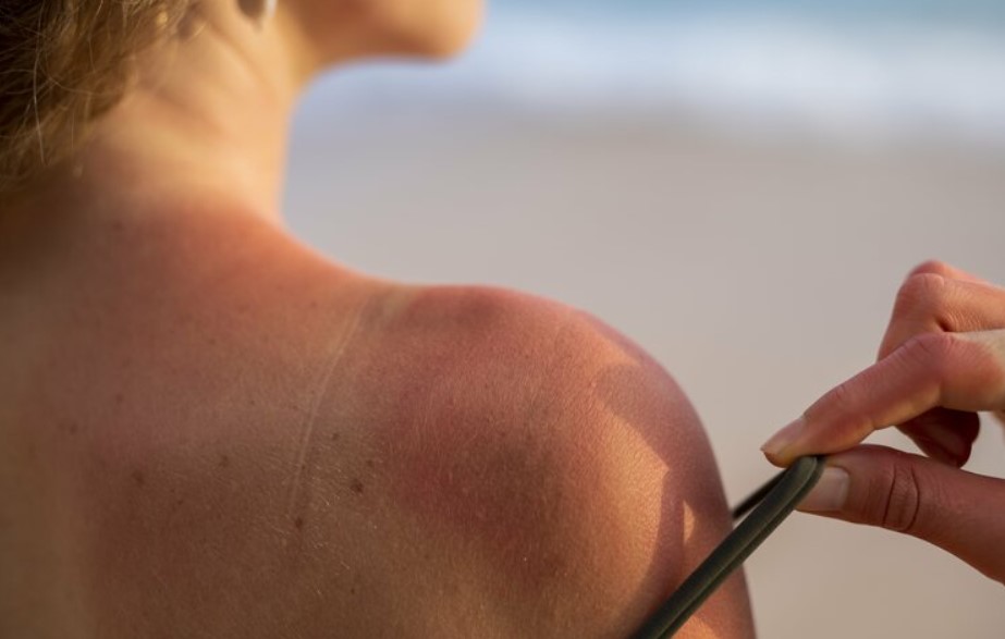 Tips dan Trik Efektif Atasi Kulit Terbakar Sinar Matahari Saat Berenang di Laut